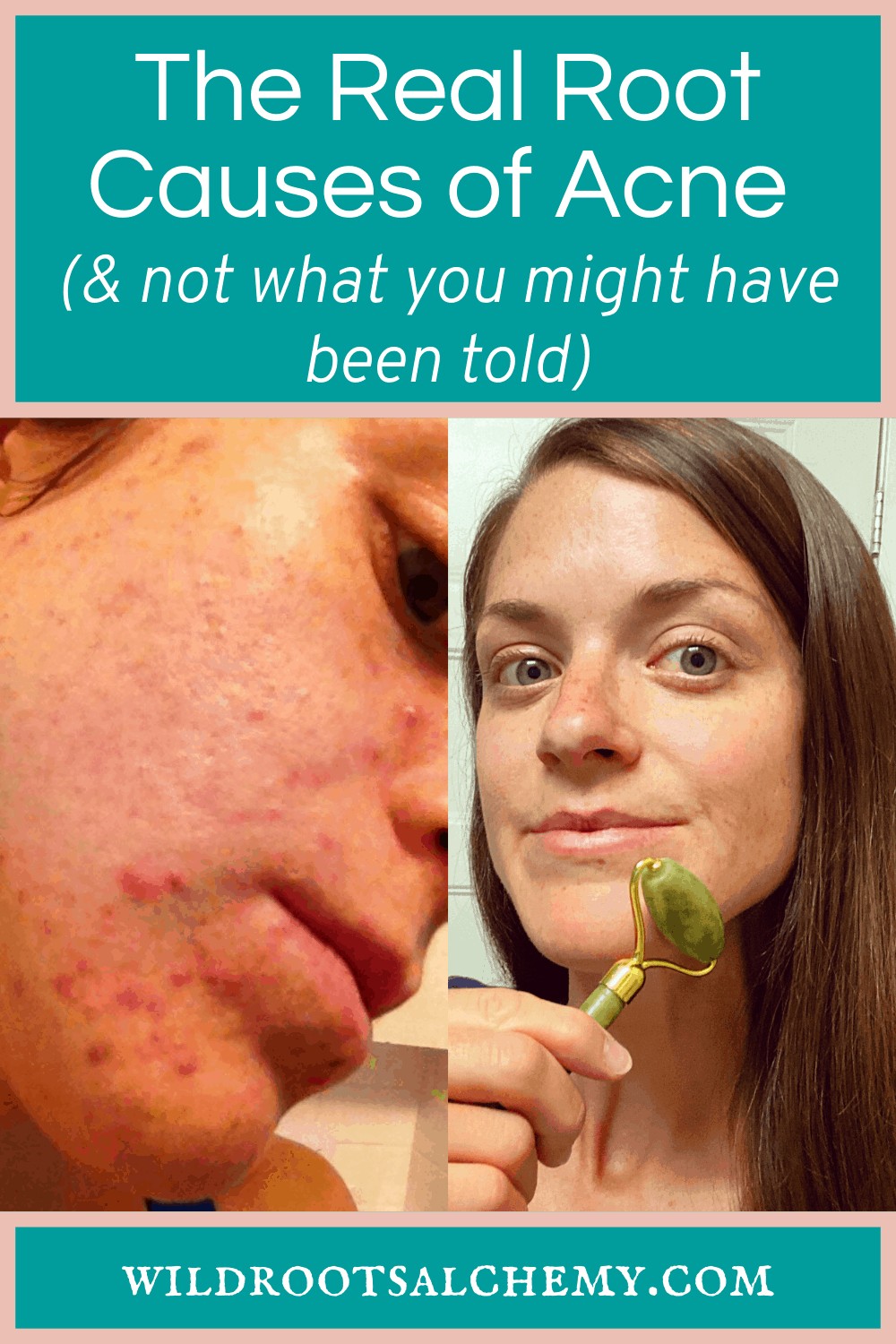 the-real-root-causes-of-acne-not-what-you-might-have-been-told