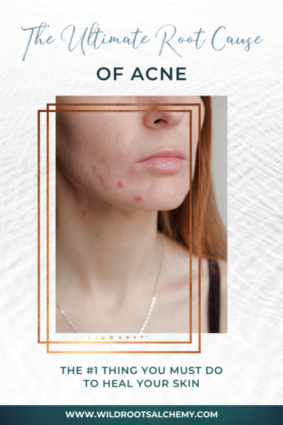 ultimate root cause of acne mind body connection mental emotional healing