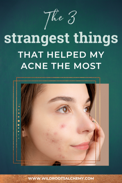 3 strangest things that helped my acne the most