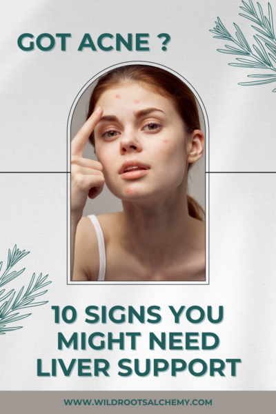 acne 10 signs you need liver support