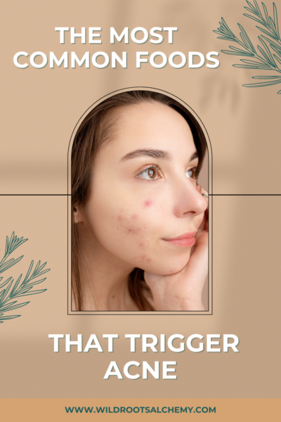 acne food triggers