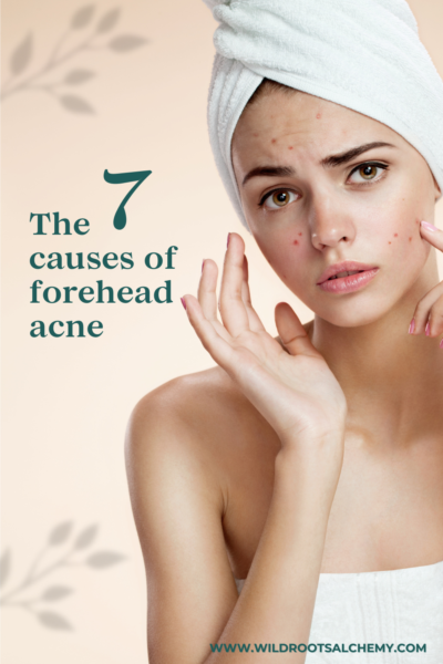 forehead acne causes